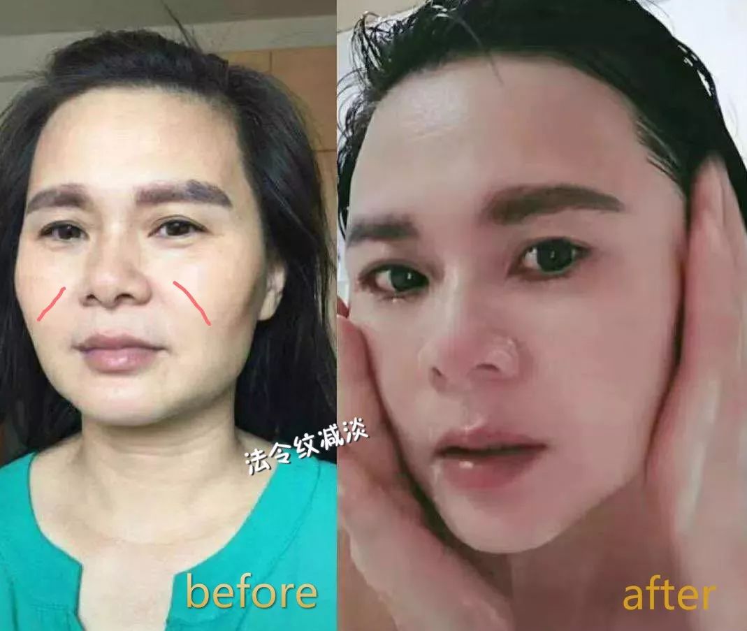 一招帮你搞定淡化法令纹,教你一招二天消除法令纹