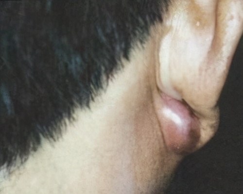 洗头耳朵化脓,洗头水进耳朵流脓