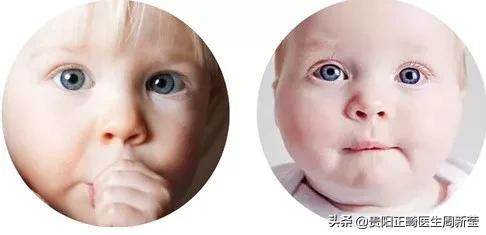 龅牙怎么变好看,龅牙笑起来很难看改善方法