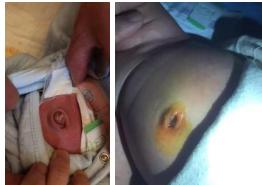 婴儿肚脐化脓新闻,出生小孩肚脐感染怎么办