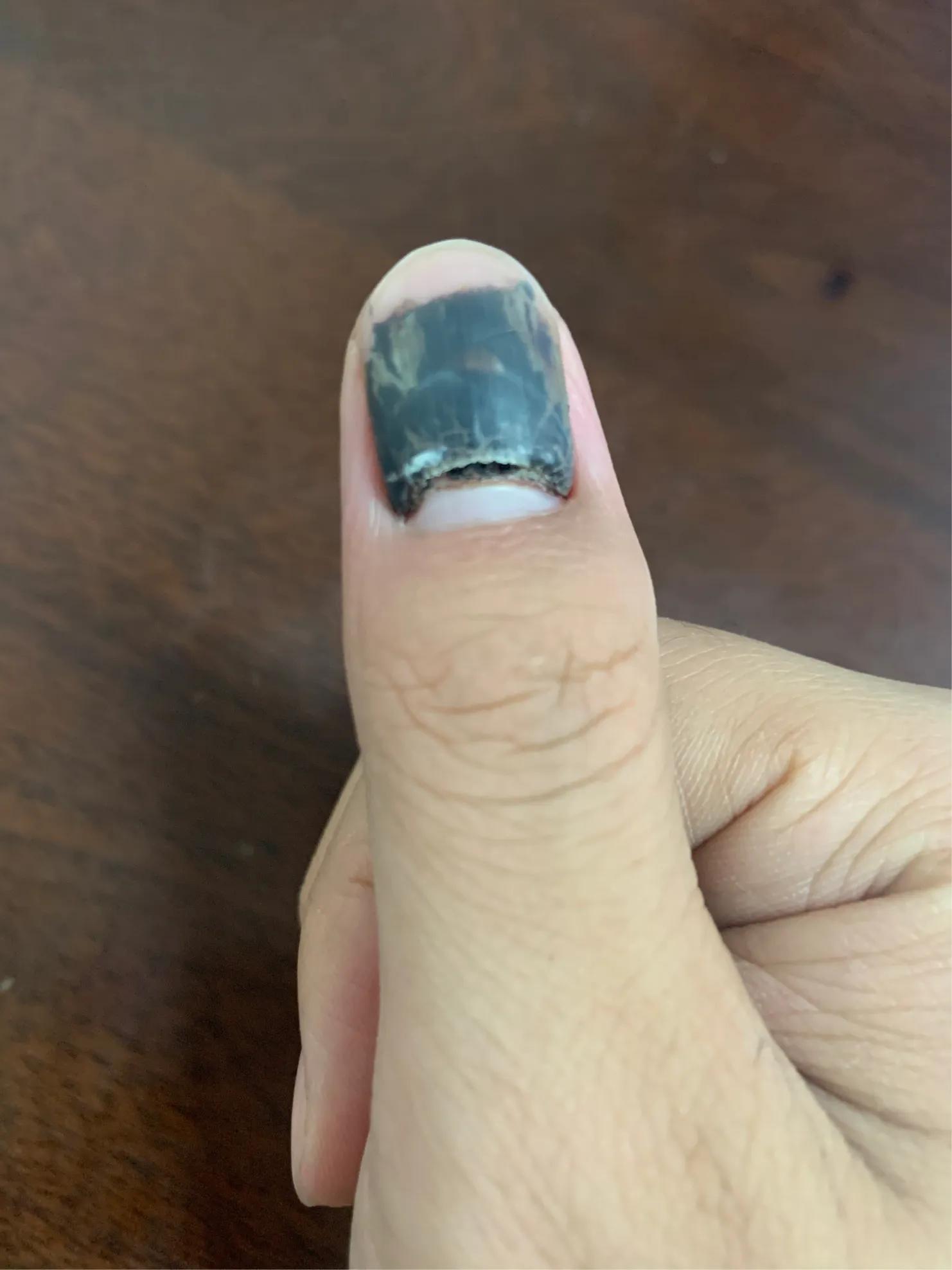 手指被夹出淤血该怎么办,手指被门夹淤血疼到睡不着