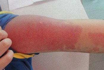 浅表性血管瘤用眼药水能治好吗,什么眼药水可以祛血管瘤