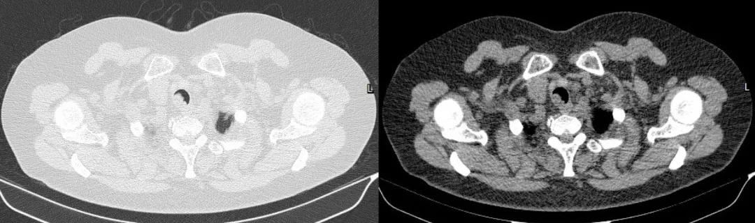 儿童90%为良性，成人却不到10%？患者气短3年，胸部CT提示的气管肿物意味着什么？气管镜有何发现？