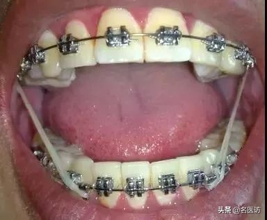 2020牙齿矫正攻略请查收,今日头条修复牙齿