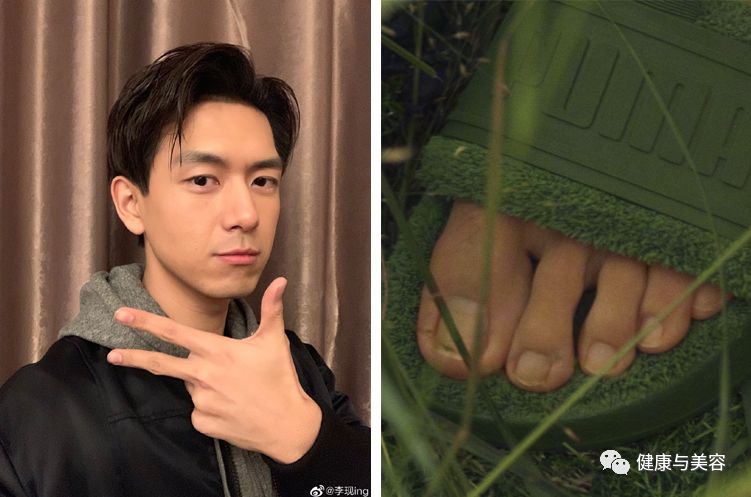 脚趾甲已经剪成圆形怎么办,脚趾甲长进肉怎么剪才不会痛