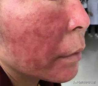 春暖花开过敏症状,春暖花开时预防过敏方法