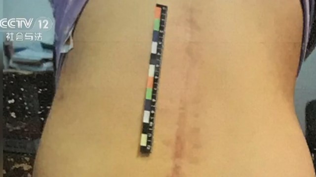 18岁女孩从高空坠落,17岁少女从17楼跳下毫发无伤