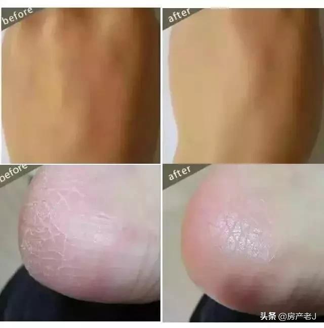 腿上长鱼鳞片状的皮屑怎么办,腿上起皮屑就是鱼鳞病