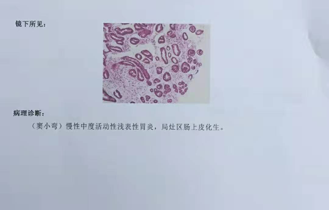 胃糜烂伴中度肠化转化成癌的过程,胃出现肠化能恢复吗