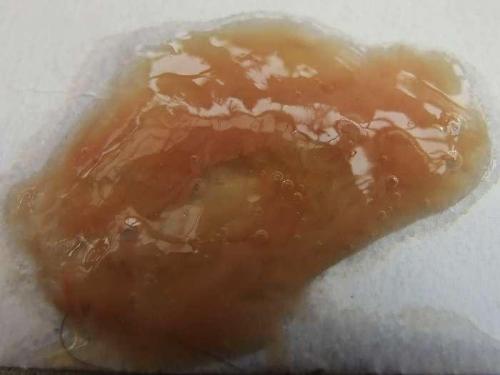 咽喉有痰胸口堵是什么原因,早上起床咽喉有黄痰是什么原因