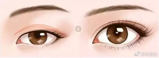 科普篇眼部整形的七大误区,关于眼整形这些事你一定要知道