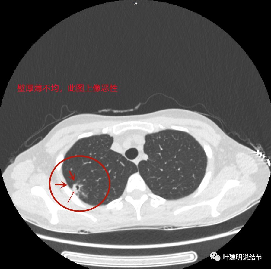 临床诊断孤立性肺结节,空洞型结节一般是什么性质
