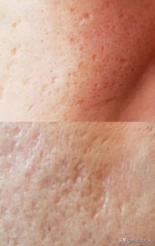 脸上小痘坑怎么修复,痘坑到底能不能修复