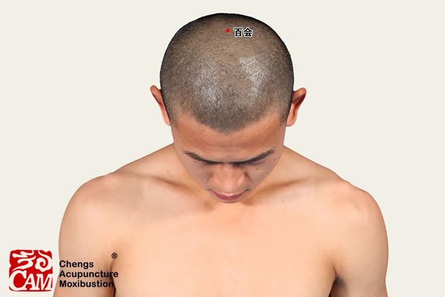 月经过少针灸穴位,月经过少埋线