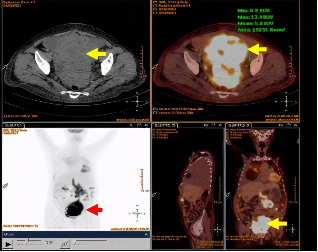 胸腔积液并有顽固性咳嗽,胸腔积液无症状