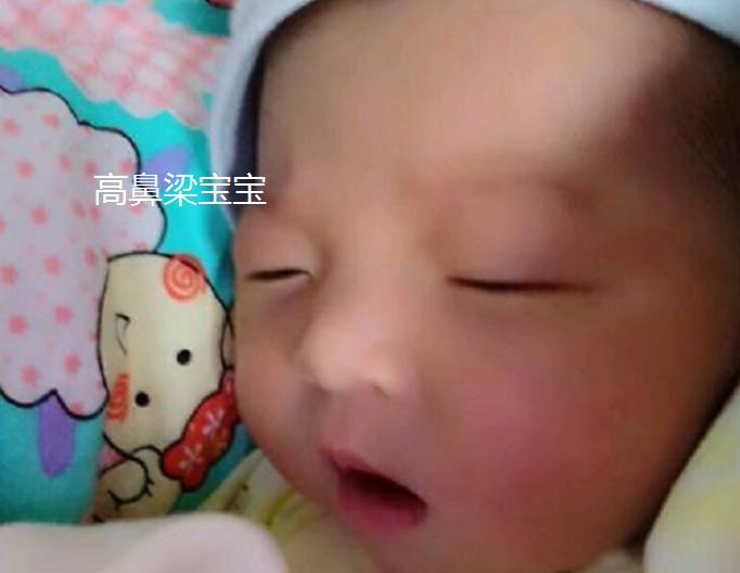 婴儿塌鼻梁怎么改善,宝宝的鼻梁