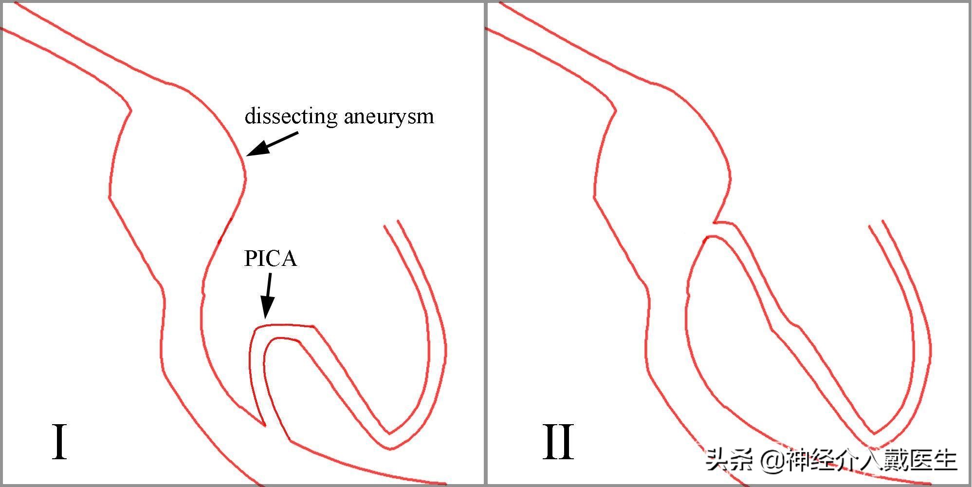 神经外科手术动脉瘤,湖南省人民医院脑动脉瘤介入治疗