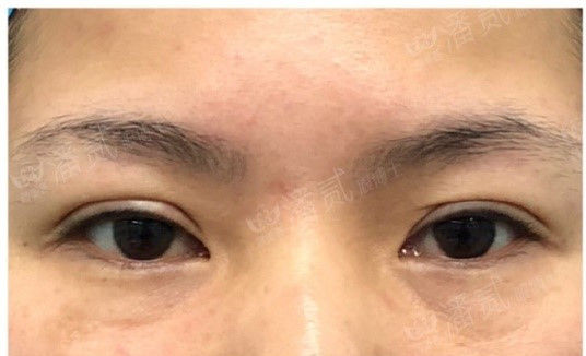 全切双眼皮提肌失败还能修复吗,什么是失败的双眼皮
