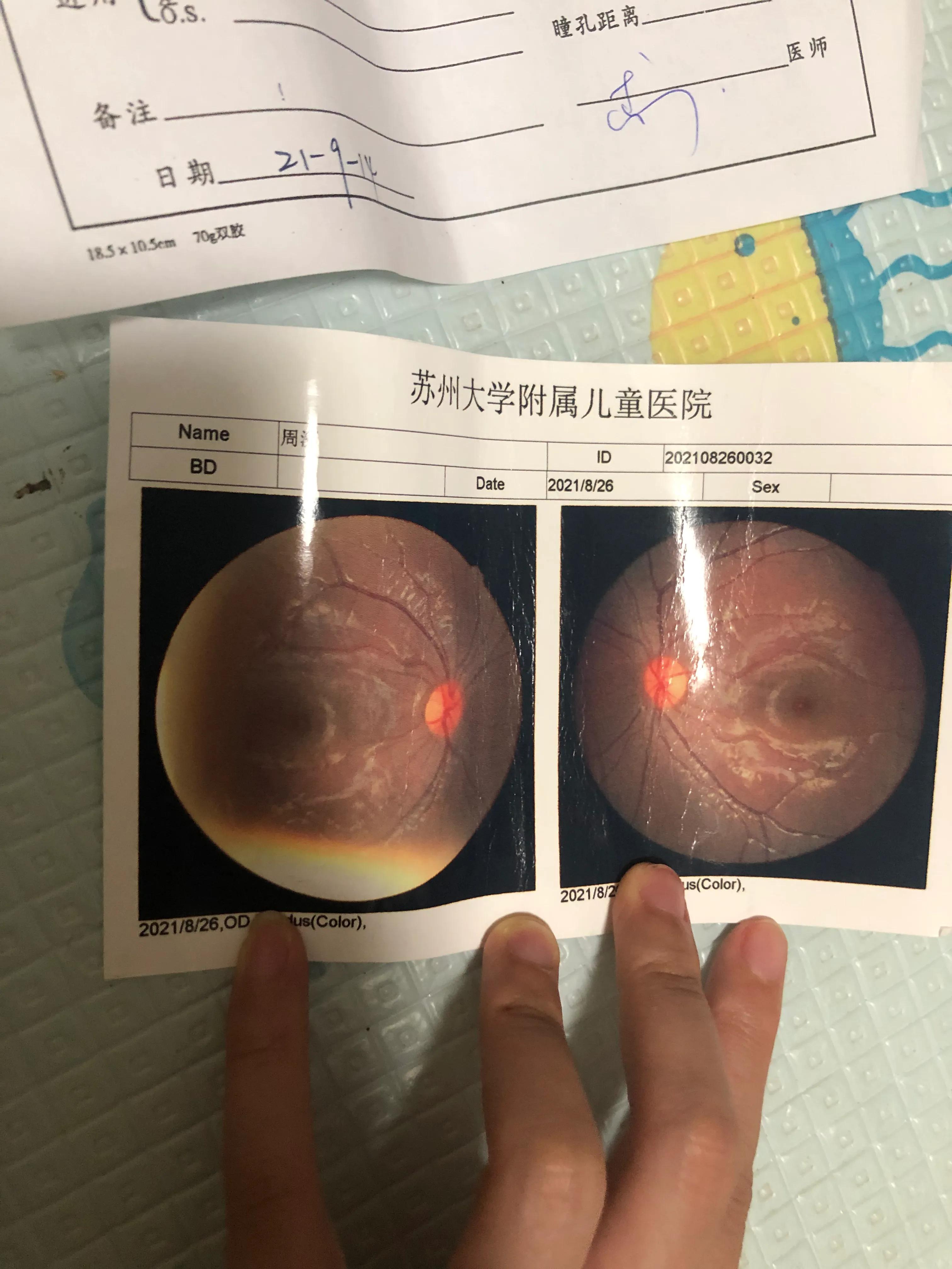 幼儿园体检散光3.0严重吗,3岁体检散光