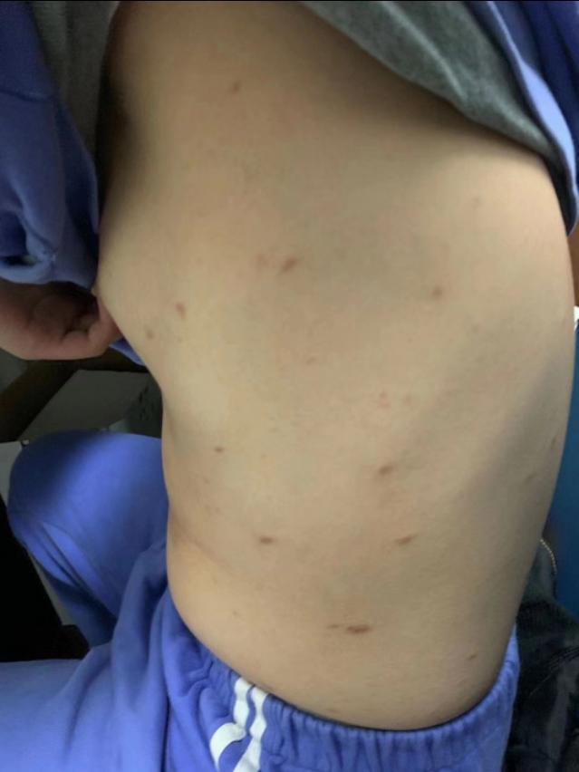 中医治疗皮肤痒的最好方法,中医治疗皮肤纤维瘤