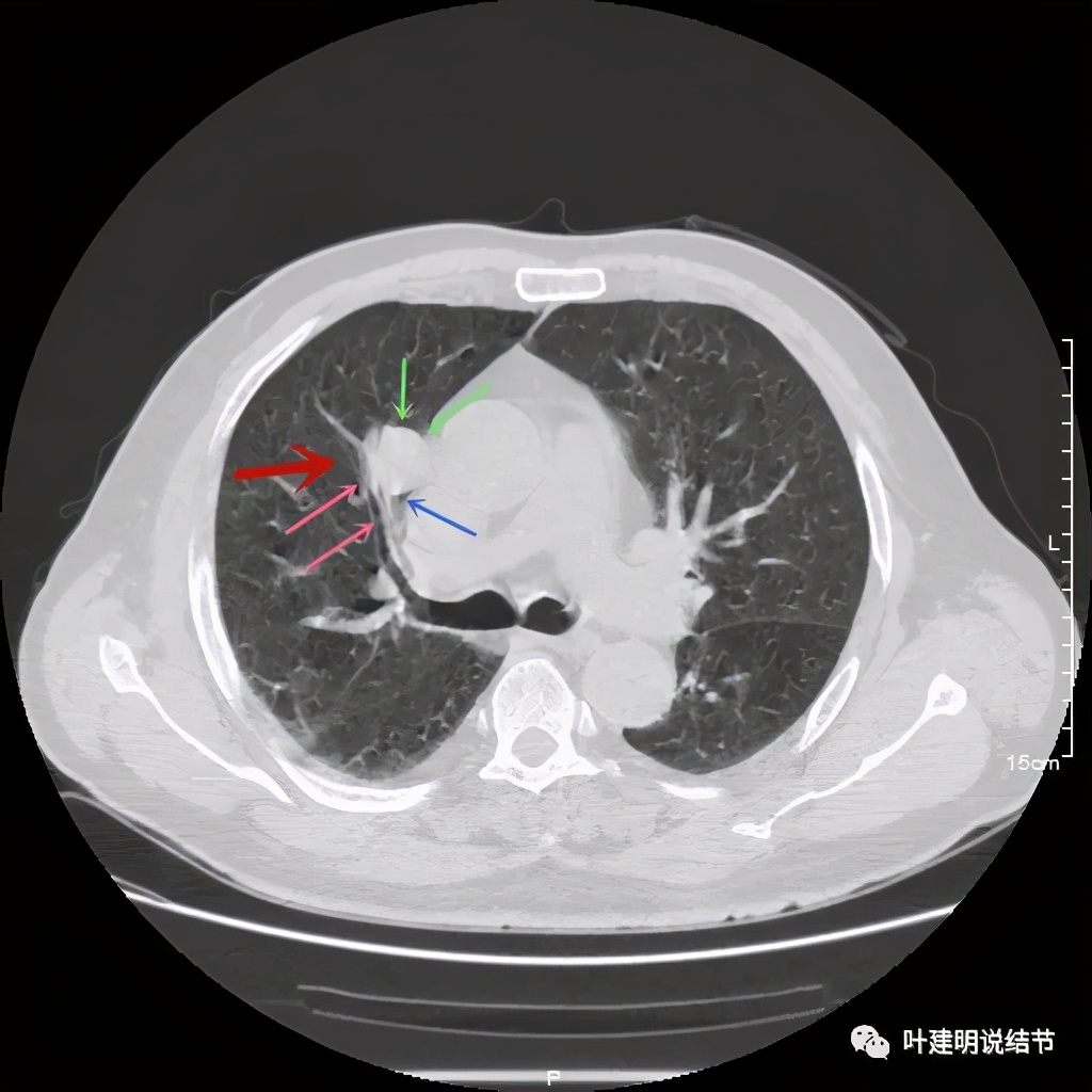 误诊报告图片,误诊案例及案例分析