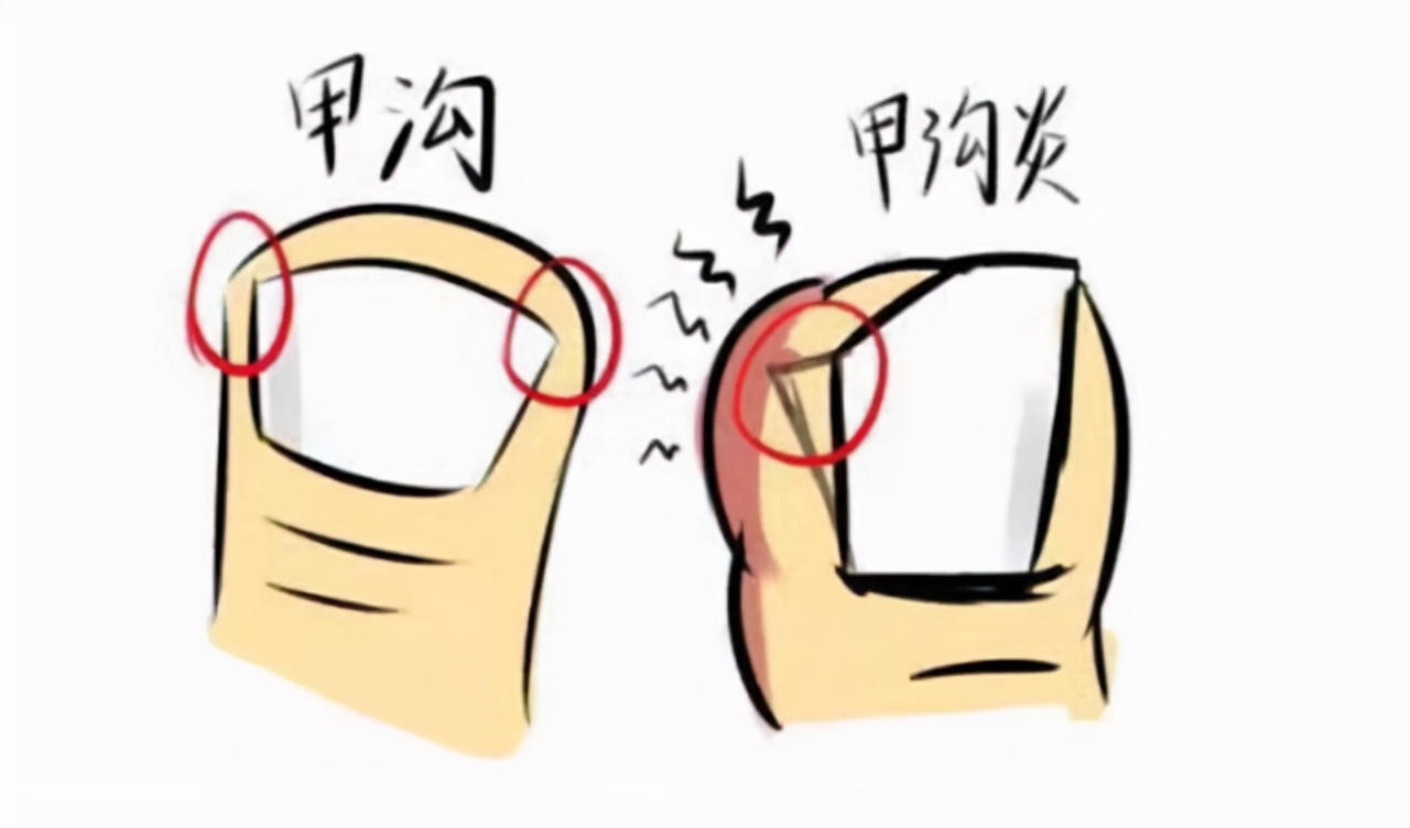 甲沟炎拔掉脚趾甲的过程,大脚趾甲重新长出来要多久