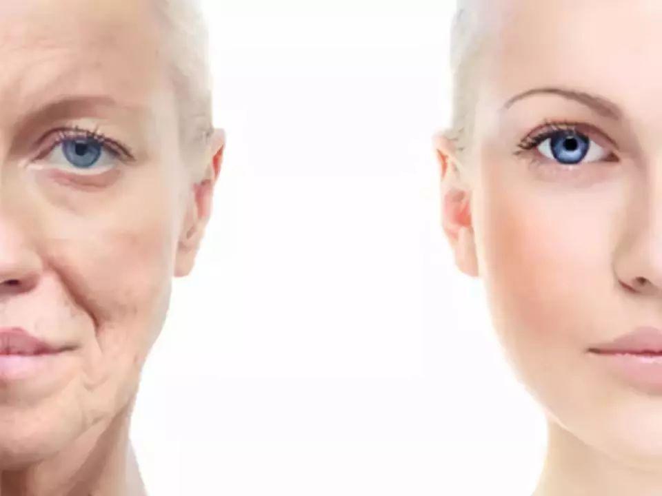 爱笑导致的法令纹太深了怎么办呢,爱笑的人怎么去除法令纹