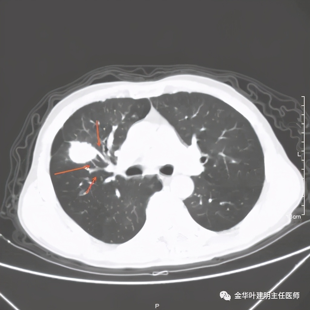 左肺占位被安排穿刺活检是肺癌吗,肺癌肺部穿刺有什么危险