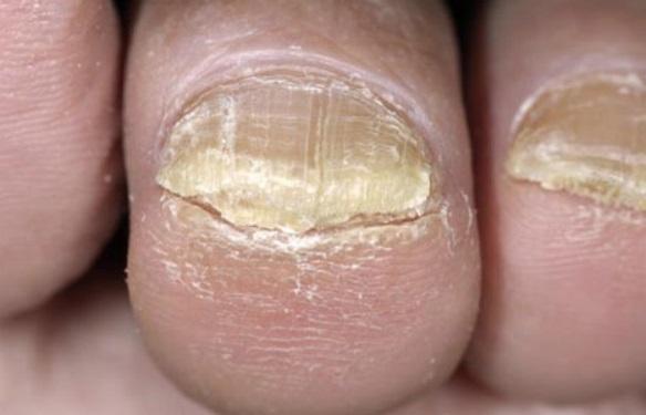 脚上有病有什么征兆,脚上有这三种症状赶紧去医院