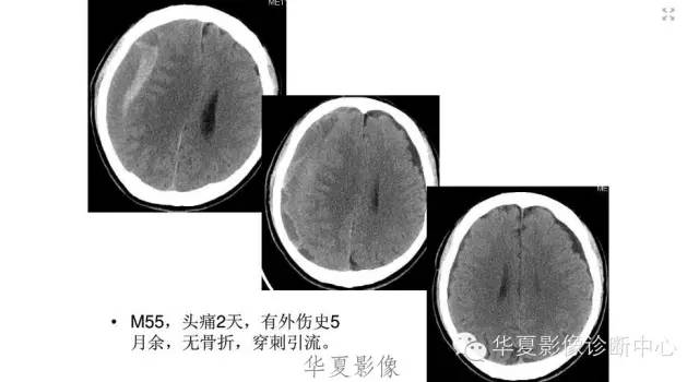 一文读懂颅内胆脂瘤,一文看懂背后的真相