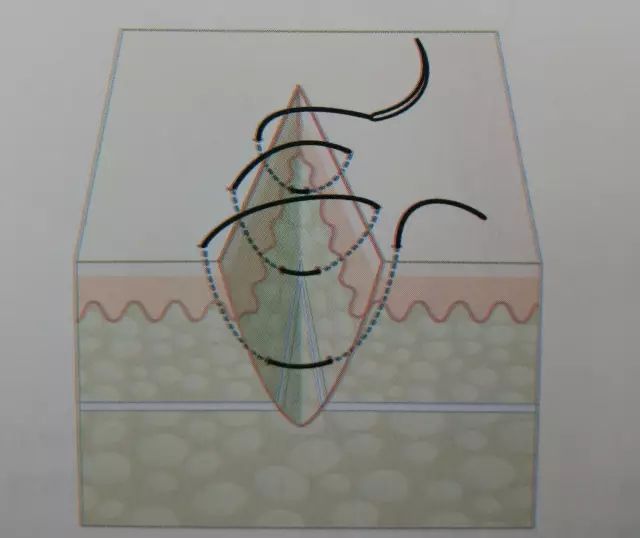 伤口闭合的正确方法,伤口清创的详细步骤