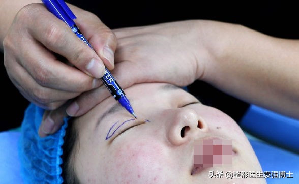 上眼皮松弛的解决办法,眼皮松了变成三角眼怎么解决