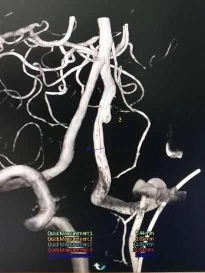 淄博市中心医院治疗动脉瘤,tubridge动脉瘤支架医保报销多少