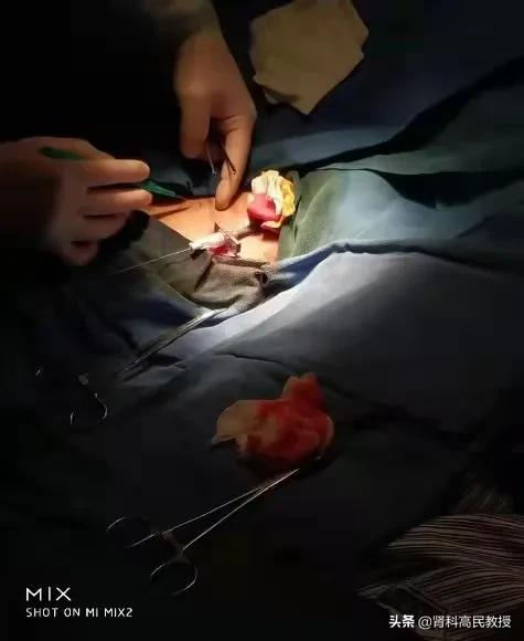 尿毒症手臂造瘘,乳腺癌十年胳膊肿了会有危险吗