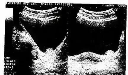 特殊性膀胱炎超声表现,特殊性膀胱炎吃什么药