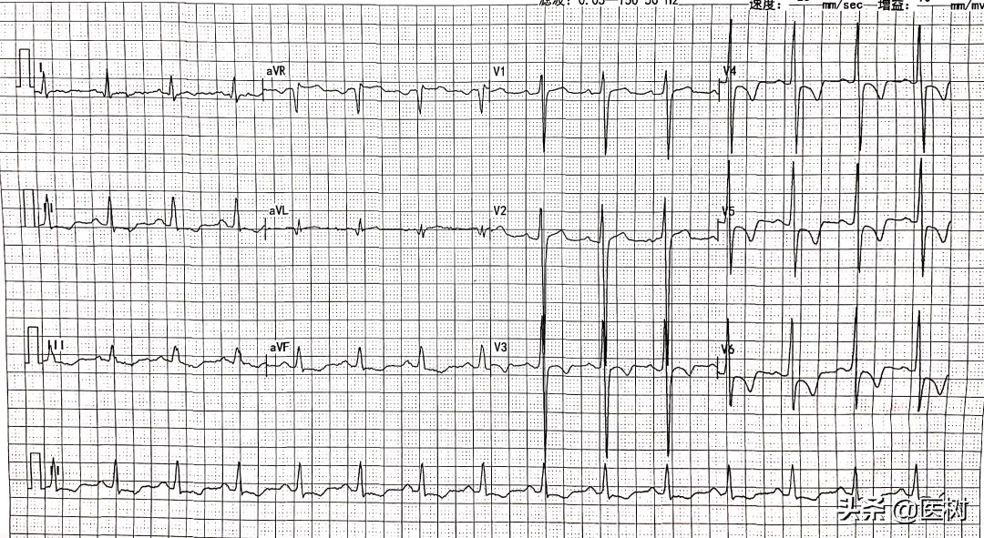 心电图t波改变是冠心病吗,心电图报告t波改变是冠心病吗