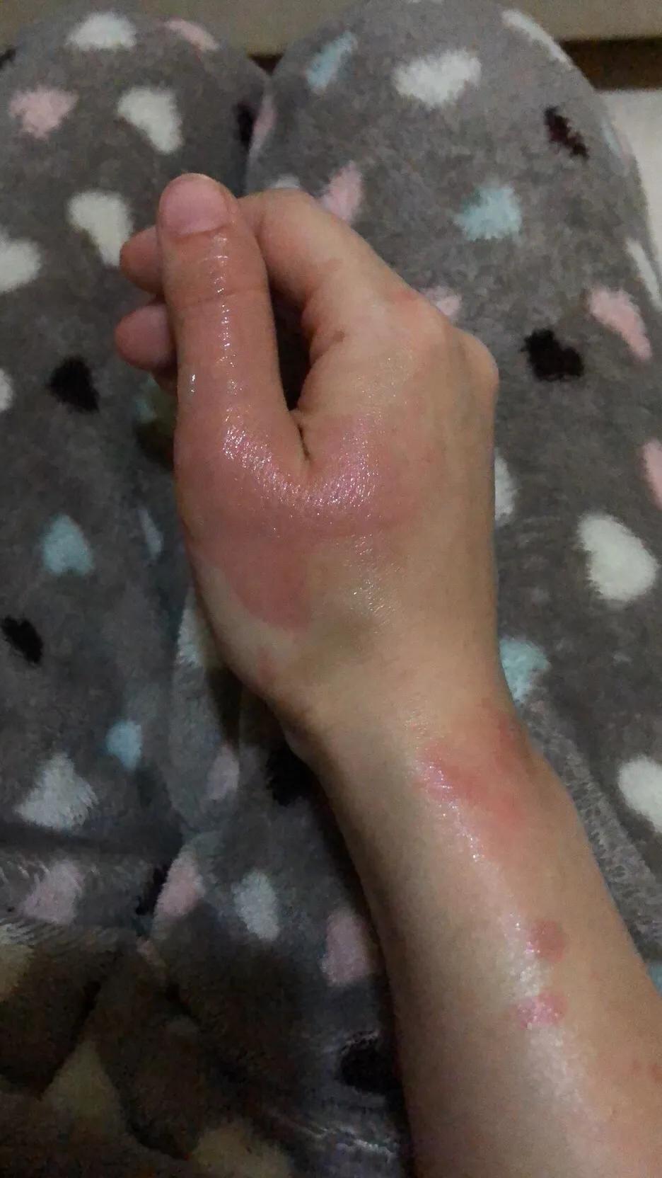 疫情期间低温烫伤的水泡怎么处理,烫伤后二十二天基本都平了