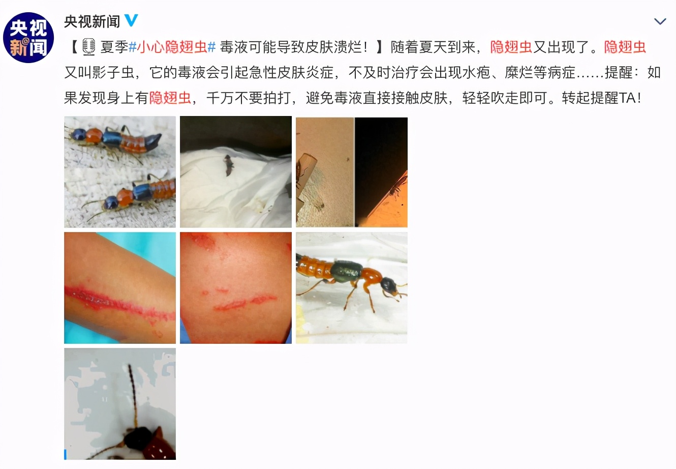 孩子碰到隐翅虫应该怎么处理,家中有宝宝发现隐翅虫怎么办