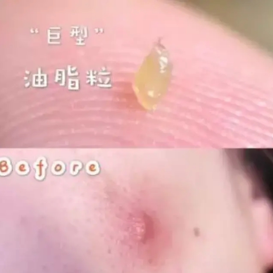 脸上小米粒疙瘩是什么问题,脸上长了白色的小米粒图片