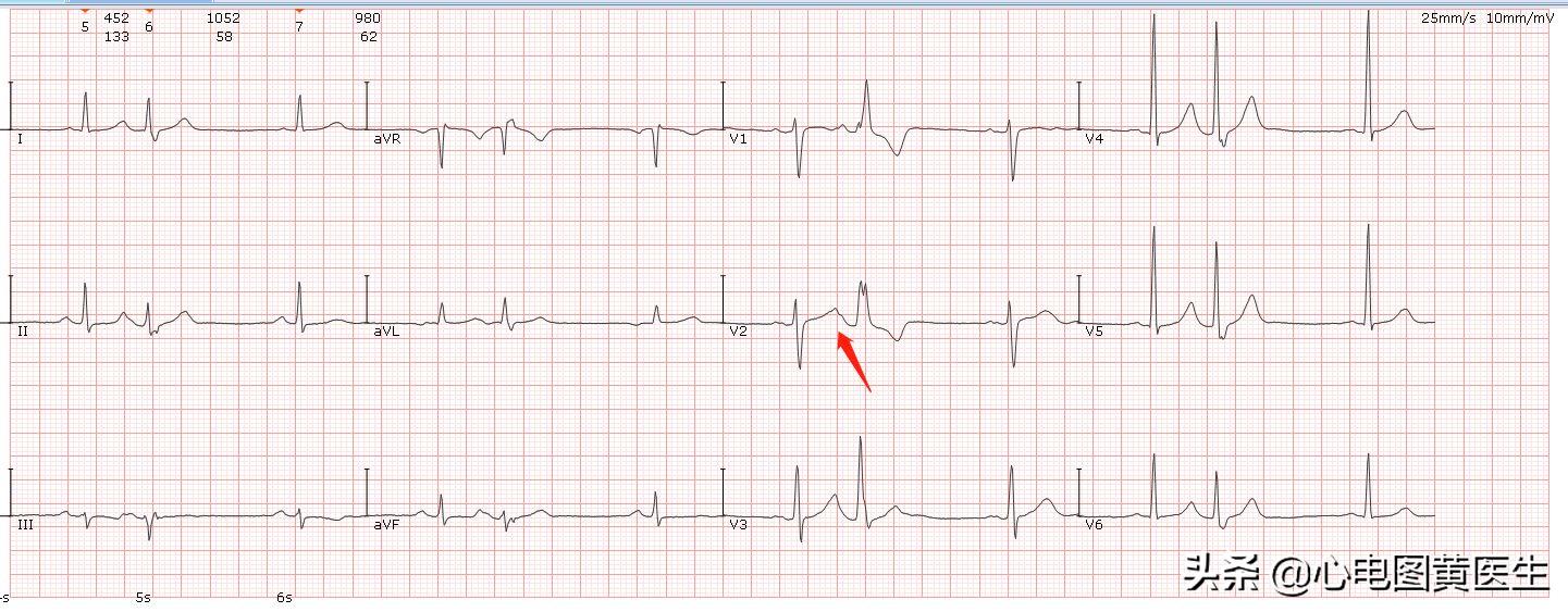 频发室性早搏部分为室性融合波,室性早搏与差异性传导鉴别