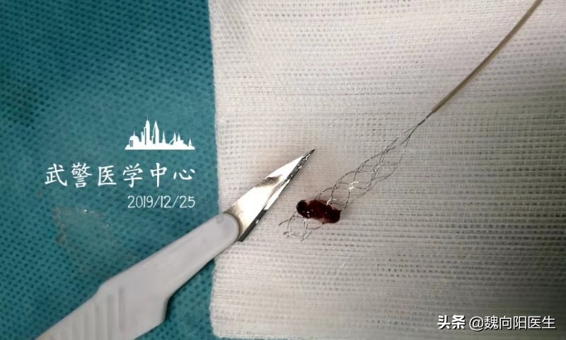 做了支架以后还能做核磁吗,支架后还能做核磁吗