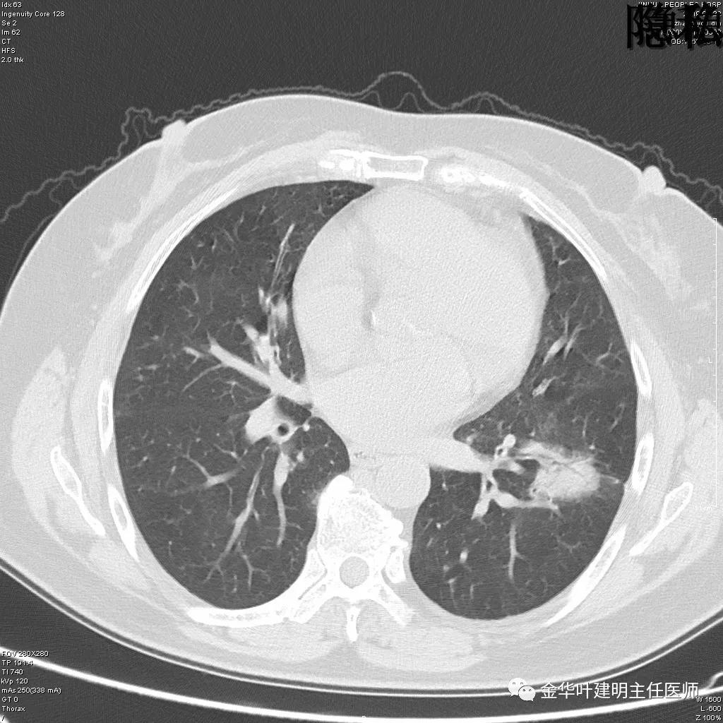 左肺下叶恶性病变,左肺上叶和下叶都有血管畸形