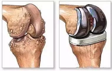 平地走路不疼上下楼痛,走路不痛上下楼痛如何治疗