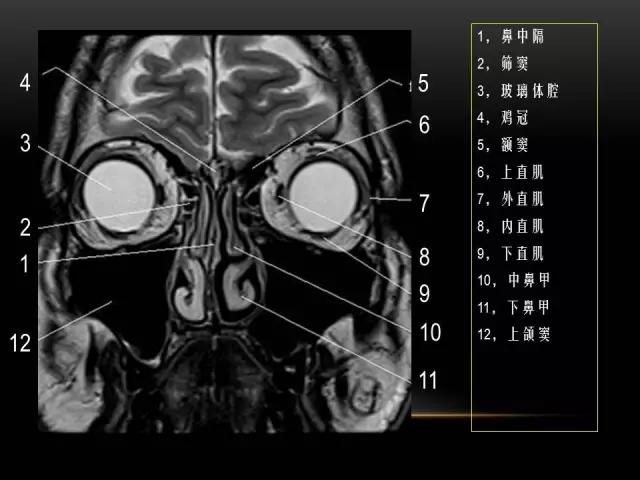 鼻腔鼻窦及颅底ct影像解剖,鼻窦解剖mri