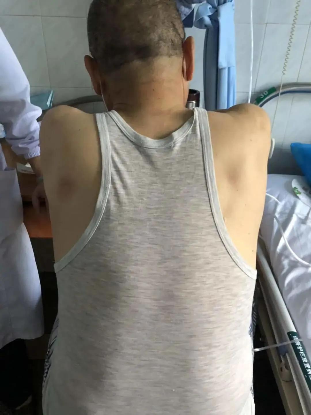 肩膀疼沉重是什么原因,肩膀背部呼吸时候很酸痛怎么回事