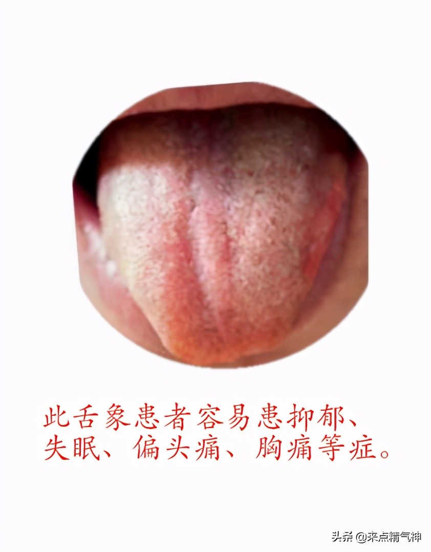 舌头胖大暗红色是什么原因,舌头有红色斑点中医说是什么原因