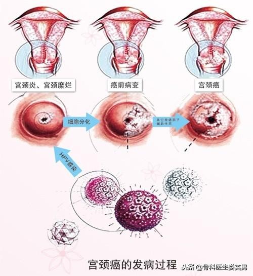 得了宫颈癌别放弃,宫颈癌该如何自救