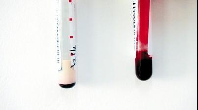 医院空腹采血时间,空腹采血怎样才算空腹