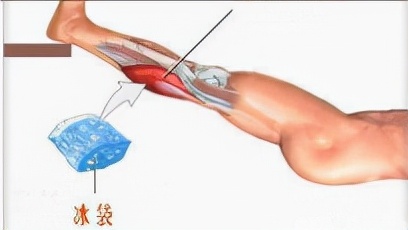 运动损伤的早期处理方案,急性运动损伤最佳治疗方法