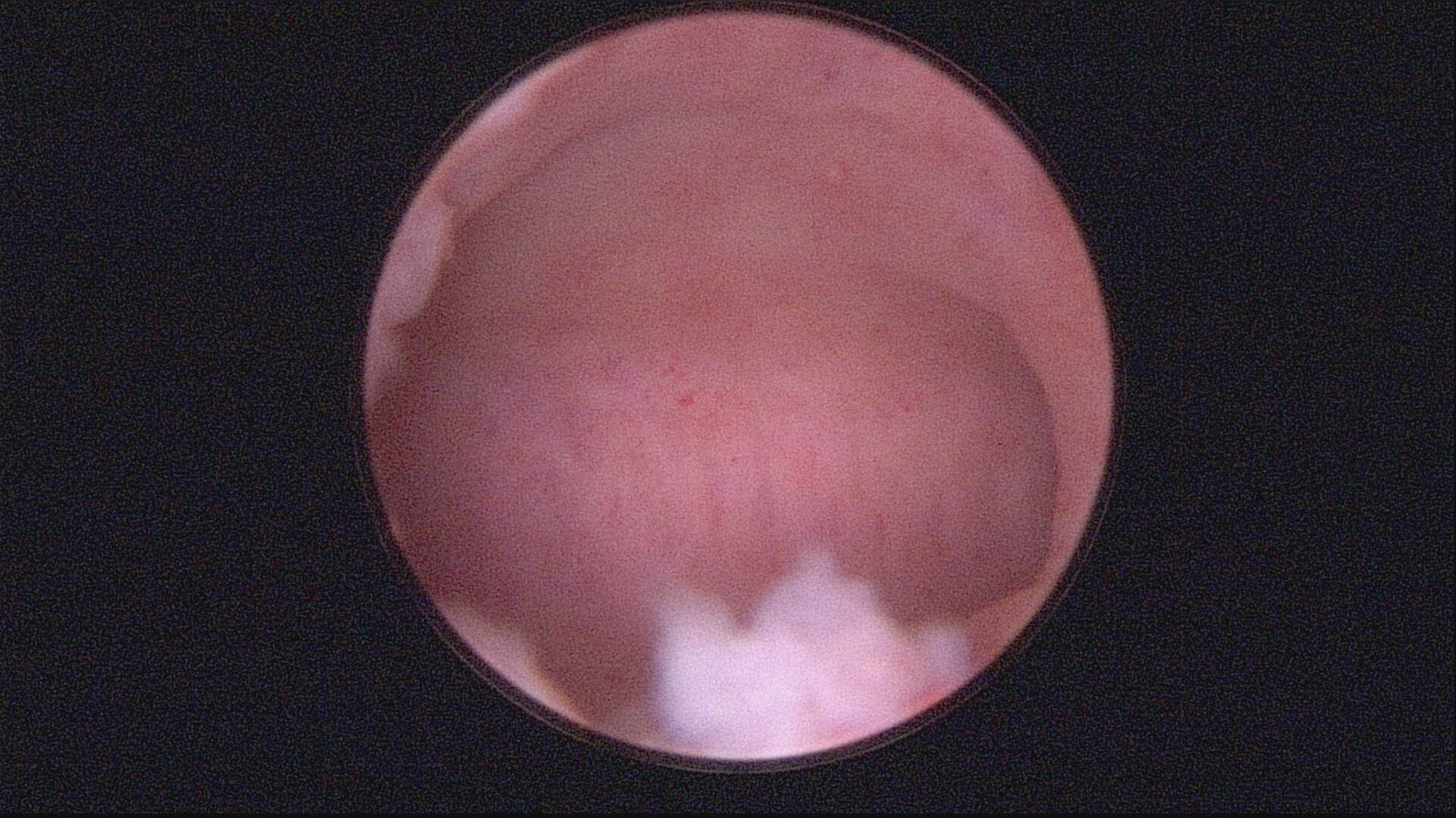 安徽宫腔镜手术专家排名,安徽省立宫腔镜哪个医生做的好